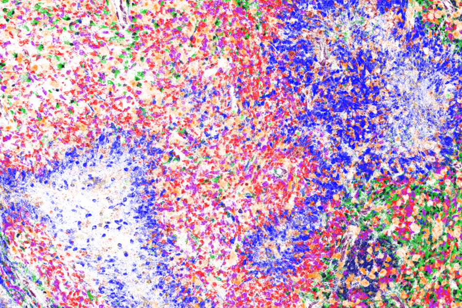 Tumor microenvironment of glioblastoma. Colors denote different cell-types.